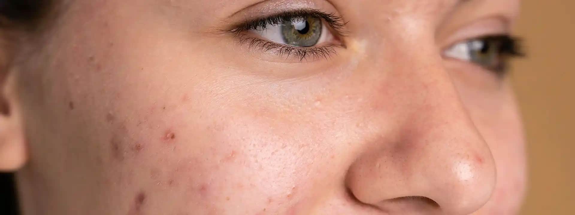 Gözenek Genişlemesi Nedenleri ve Etkili Sıkılaştırma Yöntemleri