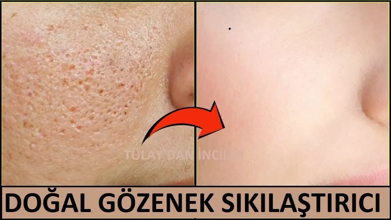 Gözenek Nedir? Genişleme ve Tıkanma Nedenleri ile Doğru Bakım Yöntemleri