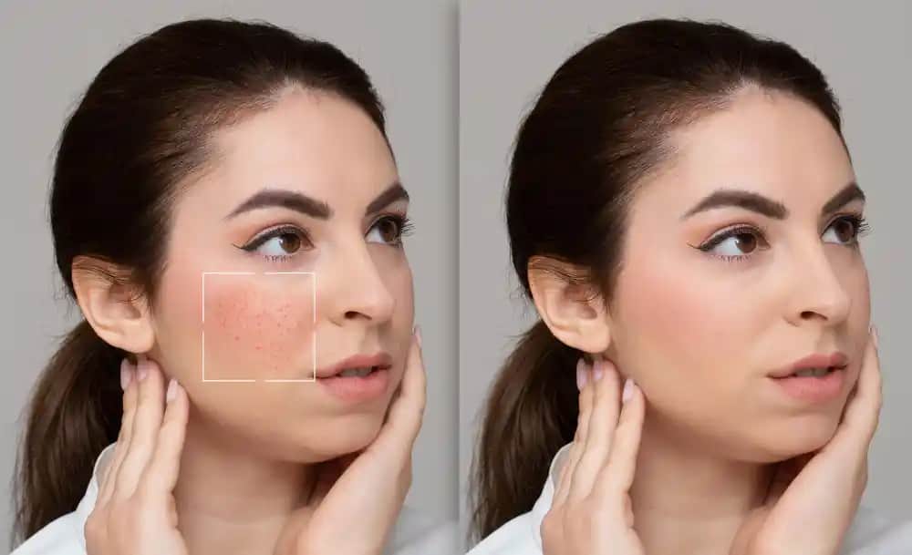 Gözenek Sıkılaştırma Tedavileri ve Cilt Sağlığını Destekleyen Yöntemler