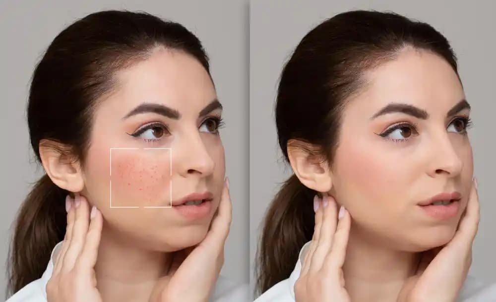 Gözenek Sıkılaştırma Tedavileri ve Cilt Sağlığını Destekleyen Yöntemler