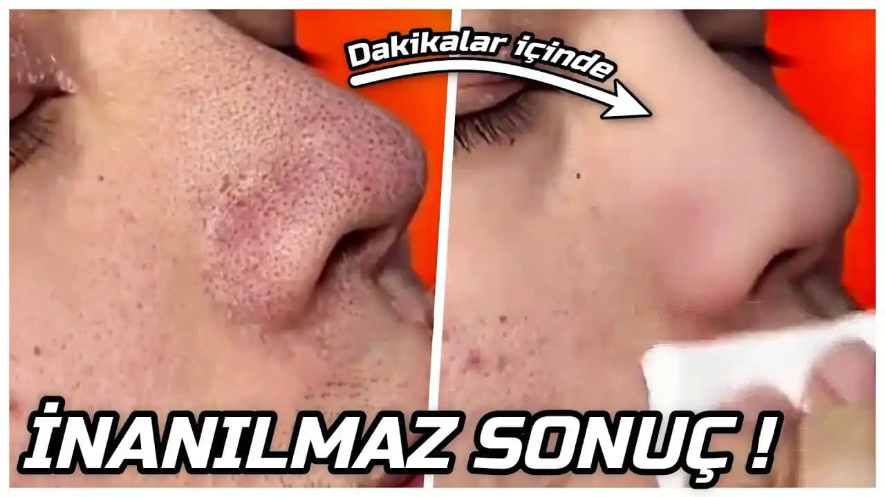 Gözenek Yok Edici Ürünler ve Cilt Bakımında Etkileri Hakkında Kapsamlı Rehber