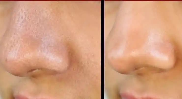 Gözenekli Burun Nedenleri, Tedavi Yöntemleri ve Günlük Bakım Tavsiyeleri