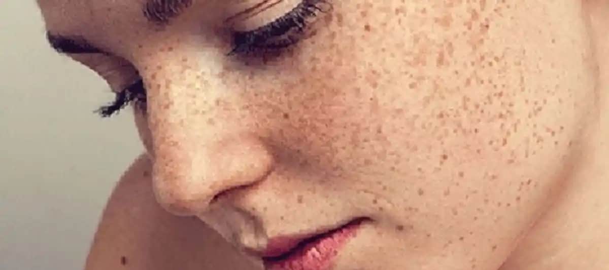 Güneş Lekeleri Neden Oluşur ve Etkili Korunma Yöntemleri Hakkında Bilgi