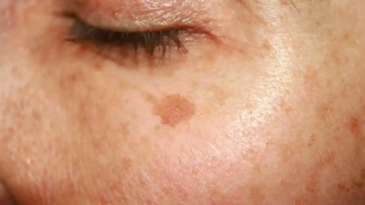 Güneş Lekeleri Nedir ve Nasıl Korunabilir veya Tedavi Edilir