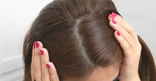 Kafa Derisi Kuruluğu Nedenleri Belirtileri ve Etkili Çözüm Yöntemleri