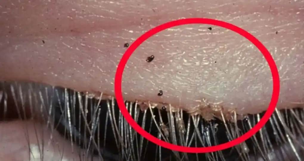 Kasık Biti Tedavi Yöntemleri ve Hijyen Kuralları Hakkında Bilmeniz Gerekenler