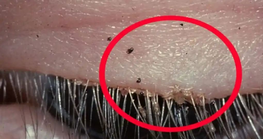 Kasık Biti Tedavi Yöntemleri ve Hijyen Kuralları Hakkında Bilmeniz Gerekenler