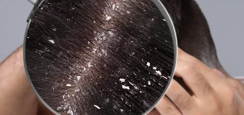 Kepeğe Karşı En Etkili Doğal Yağlar ve Saç Bakım İpuçları