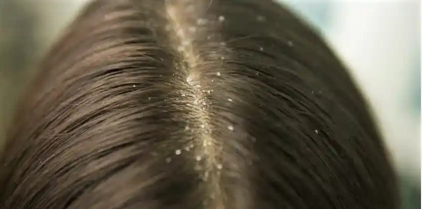 Kepek Problemi ve Çözüm Yolları: Doğru Bakım ile Kepeği Kontrol Altına Alın