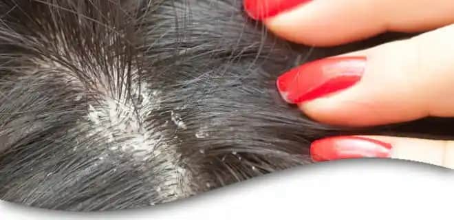 Kepekli Saçlar İçin Etkili Bakım Yöntemleri ve Sağlıklı Saçlara Ulaşma