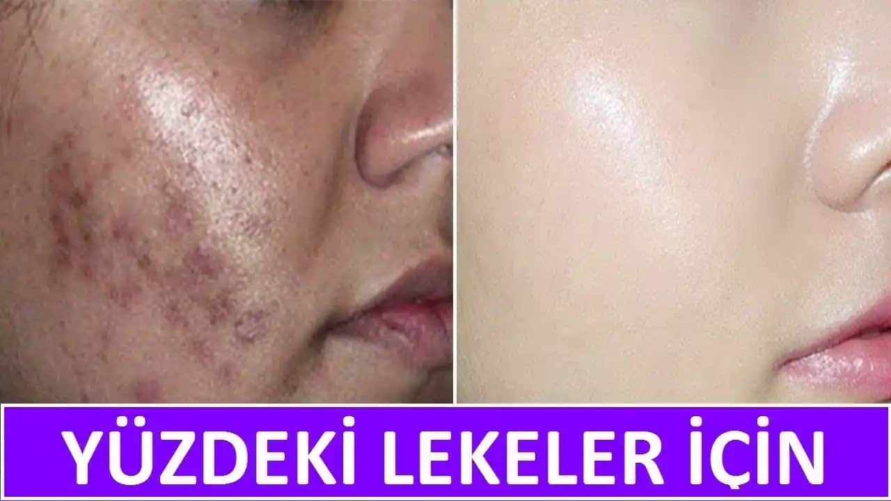 Lekeli Cilde İyi Gelen Yöntemler ve Doğru Bakım Yaklaşımları