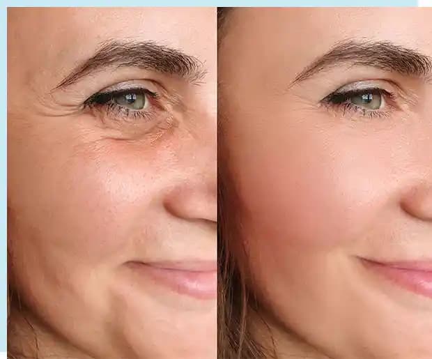 Mesolift Nedir Cilt Gençleştirme ve Yenileme Yöntemi Hakkında Detaylı Bilgi