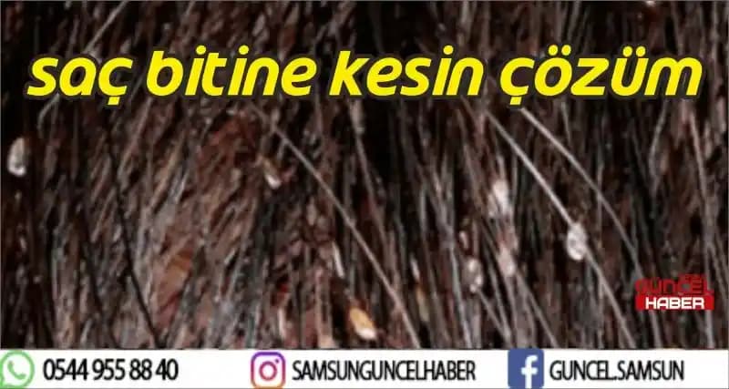 Saç Bitine Karşı Etkili ve Kalıcı Çözüm Yöntemleri Hakkında Bilgiler