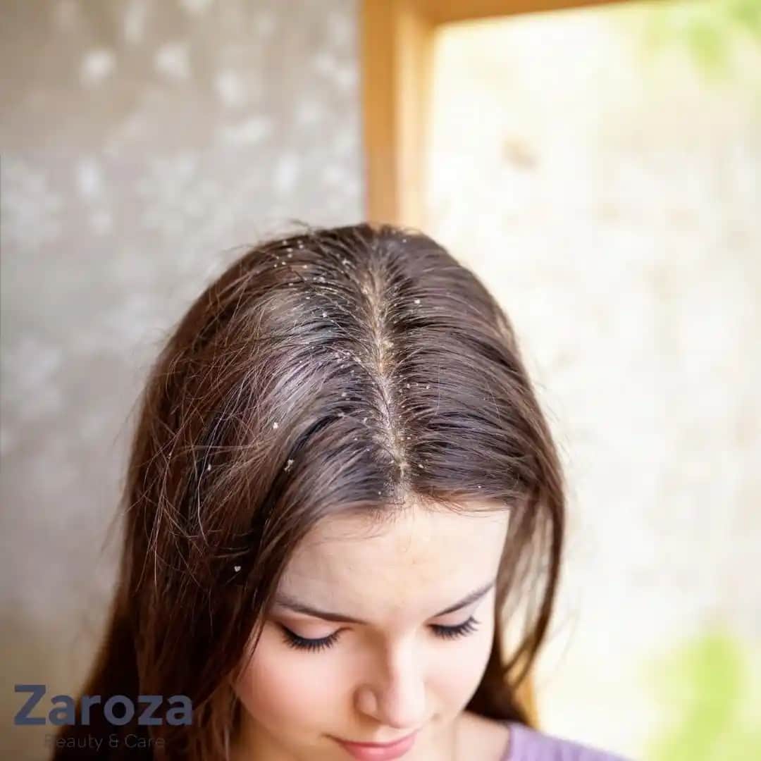 Saç Derisinde Kahverengi Lekeler: Nedenleri, Belirtileri ve Tedavi Yöntemleri