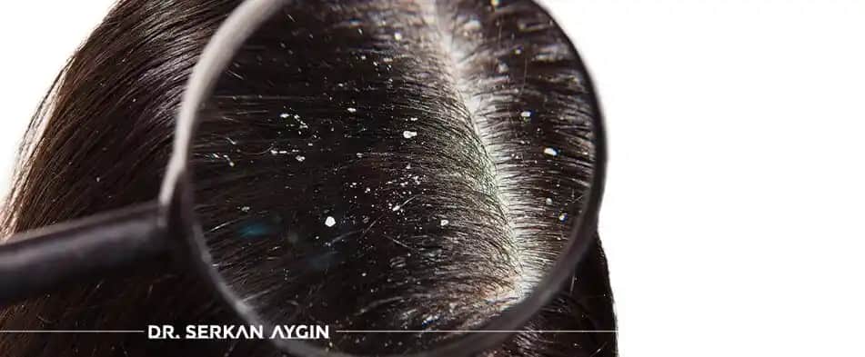 Saç Dibi Kepeklenmesi Nedenleri ve Etkili Çözüm Yolları Hakkında Kapsamlı Bilgi