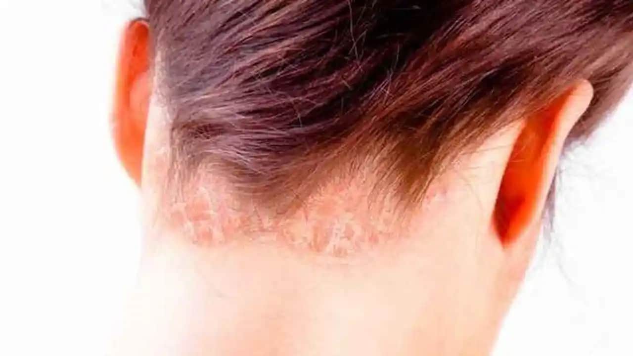 Saç Gözeneklerini Temizleme ve Açma Yöntemleri Saç Sağlığını Destekler