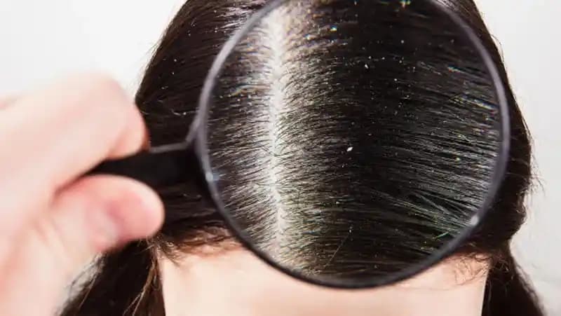 Saçta Geçmeyen Kepek: Nedenleri, Çözüm Yöntemleri ve Doğal Tedavi Alternatifleri