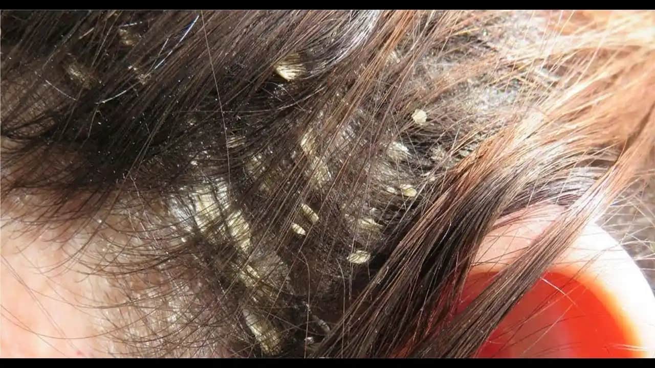 Saçta Kepek Sorunu ve Doğal Çözüm Yöntemleri Hakkında Bilgilendirici Rehber