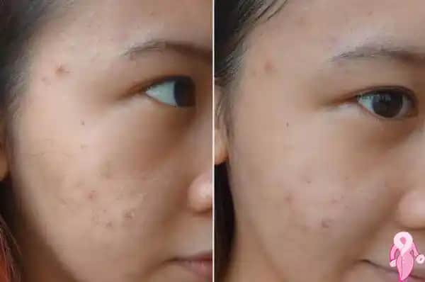 Sivilce Çıkışları Geçer mi ve En Etkili Bakım Yöntemleri Nelerdir