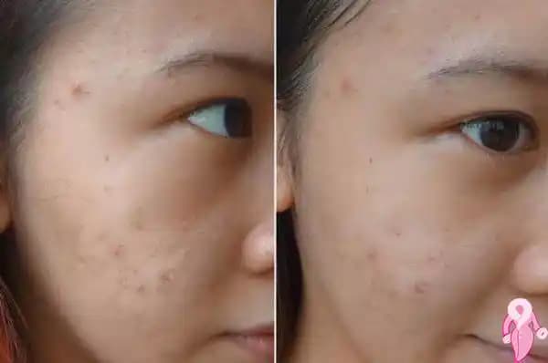 Sivilce Çıkışları Geçer mi ve En Etkili Bakım Yöntemleri Nelerdir