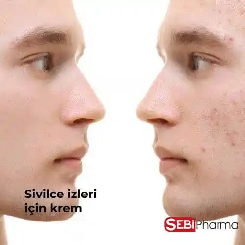 Sivilce İzleri İçin Eczaneden Temin Edilebilecek Etkili Kremler ve Kullanım İpuçları