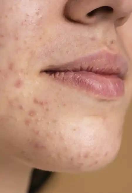 Sivilce İzleri ve Lekeleri Nasıl Geçer: Etkili Yöntemler ve Bakım Rehberi