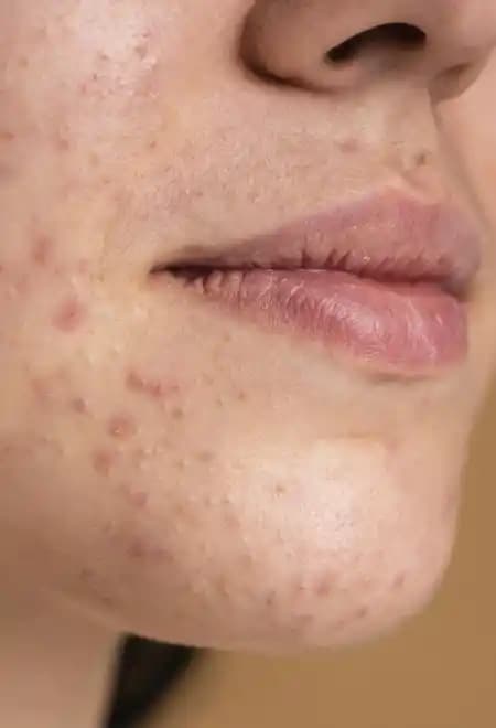 Sivilce İzleri ve Lekeleri Nasıl Geçer: Etkili Yöntemler ve Bakım Rehberi