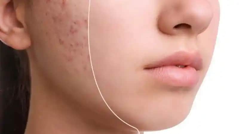 Sivilce Kaç Günde Geçer ve Cilt Sağlığını Koruma Yöntemleri