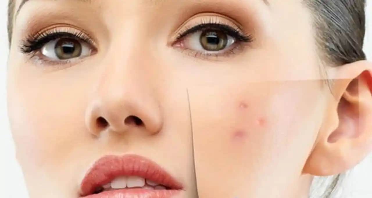 Sivilce Lekeleri Ne Kadar Sürede Geçer? Etkili Yöntemler ve Süreçler