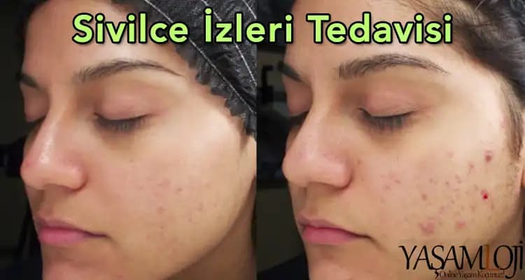Sivilce Yüzü: Cilt Sağlığını Koruma ve Tedavi Yöntemleri Hakkında Bilmeniz Gerekenler