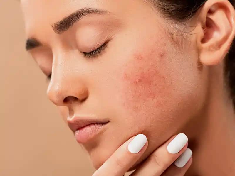 Sivilceden Sonra Kalan Kırmızı Lekelerin Giderilmesi İçin Etkili Yöntemler ve Bakım İpuçları