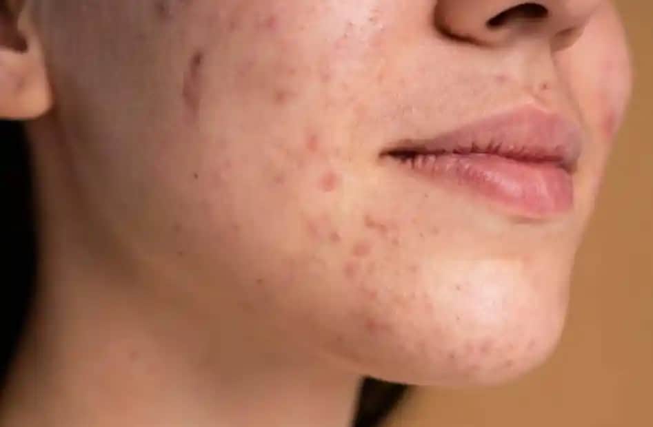 Sivilceleri Doğal Yöntemlerle Geçiren Etkili ve Güvenli Cilt Bakımı İpuçları