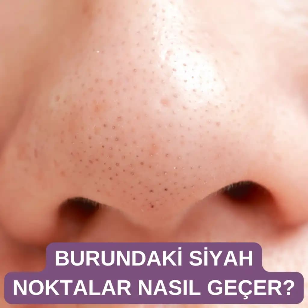 Siyah Noktalarla Mücadele ve Cilt Bakımında Etkili Yöntemler Hakkında Kapsamlı Rehber
