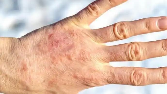 Soğuktan El Çatlaması Nedenleri Belirtileri ve Etkili Çözüm Yöntemleri