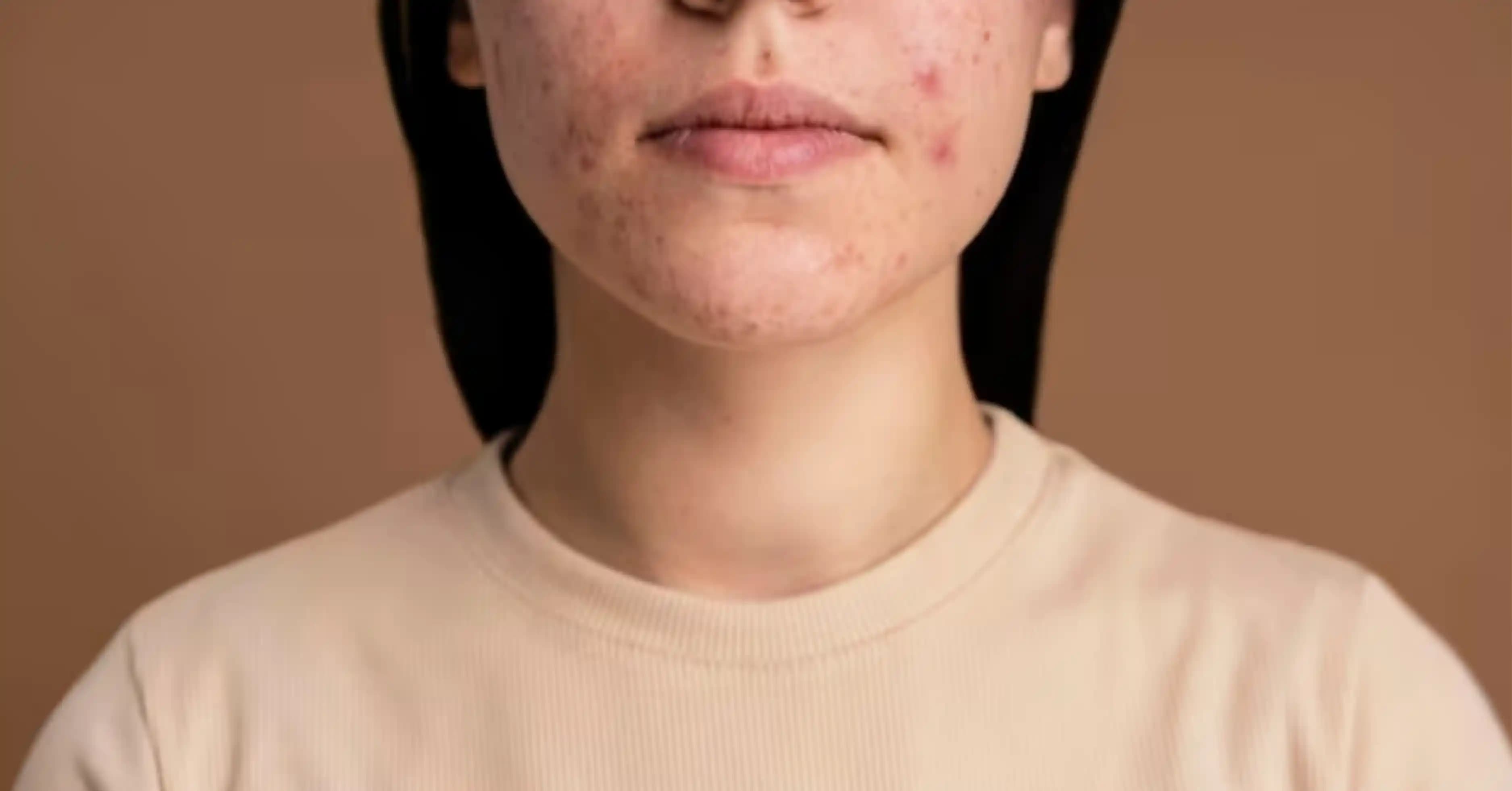 Yüz Lekeleri Nedenleri ve Etkili Tedavi Yöntemleri Hakkında Kapsamlı Bilgi