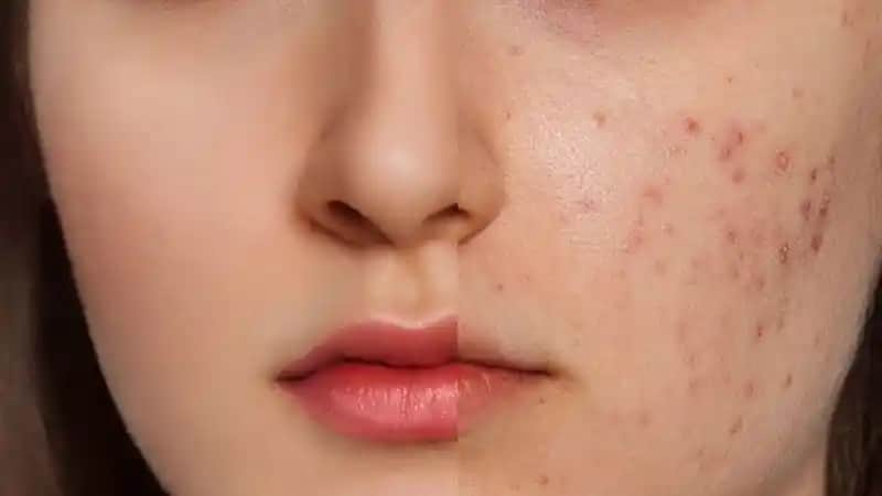 Yüz Sivilceleri Nedenleri, Tedavi Yöntemleri ve Korunma İpuçları