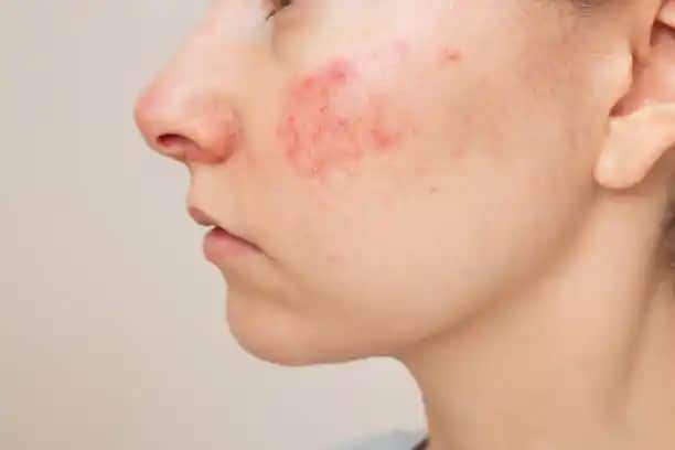 Yüz Tahrişi: Kozmetik ve Kişisel Bakımda Dikkat Edilmesi Gerekenler ve Önleme Yöntemleri