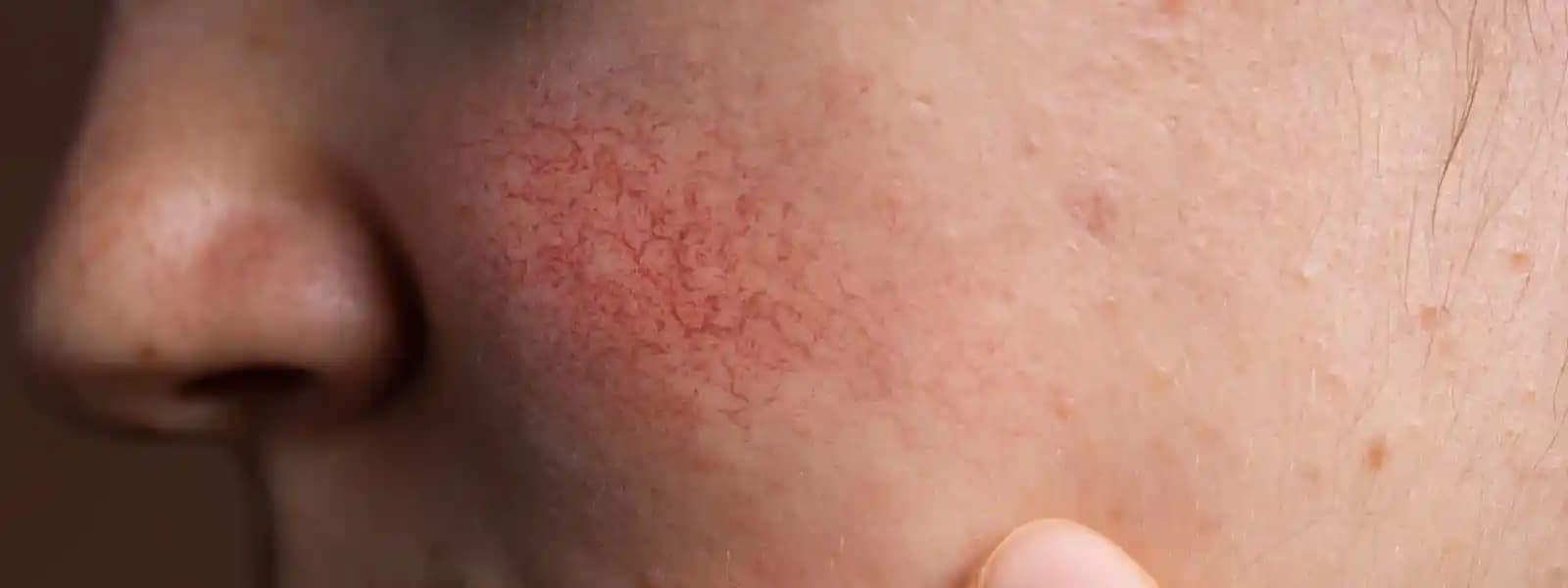 Yüzde Tahriş Nedenleri Belirtileri ve Etkili Çözüm Yöntemleri