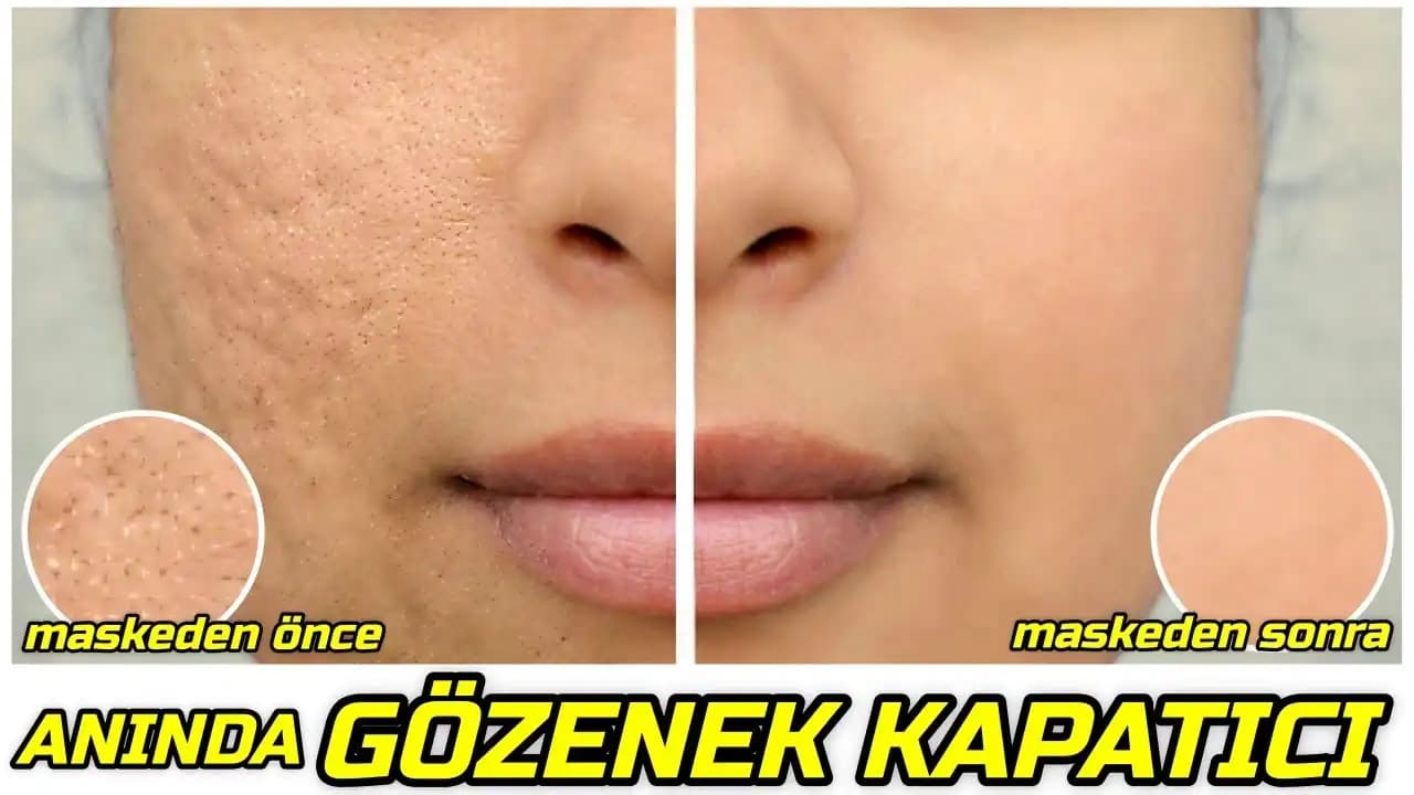 Yüzdeki Gözeneklerin Açılma Nedenleri ve Genişlemesine Karşı Etkili Çözümler