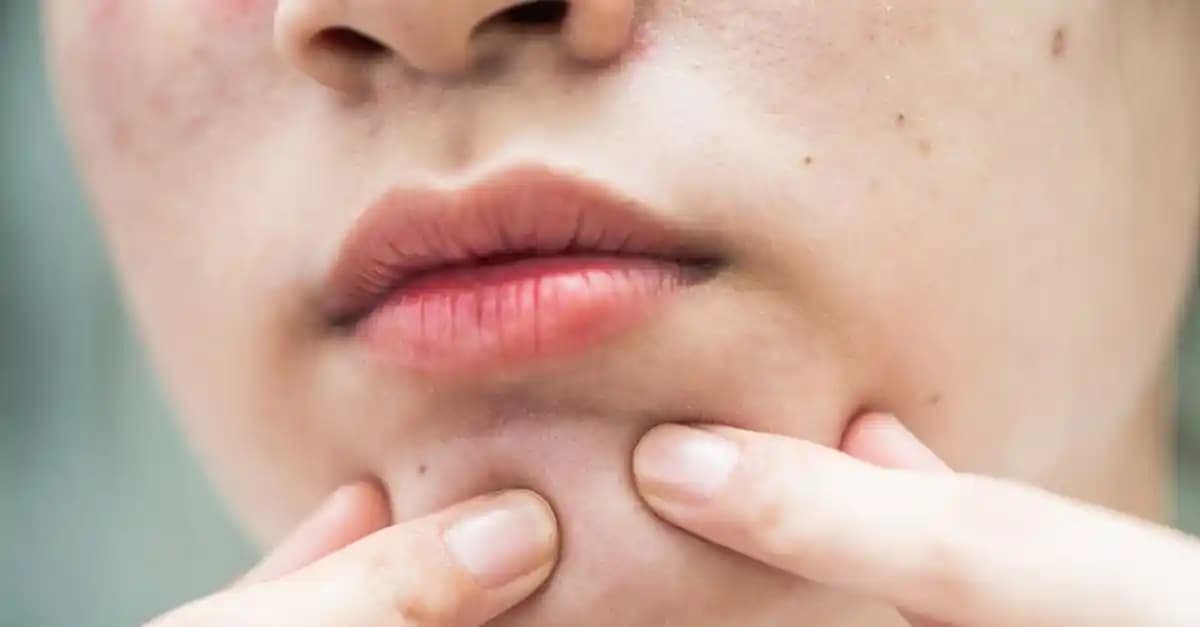 Yüzdeki Kuruluğa Karşı Etkili Doğal ve Güvenilir Çözüm Yöntemleri