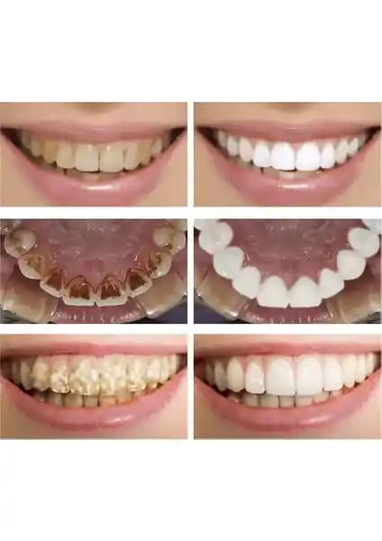 Lanbena Beyazlatıcı Diş Çubuğu: Kullanım, Etkiler ve Güvenlik Değerlendirme