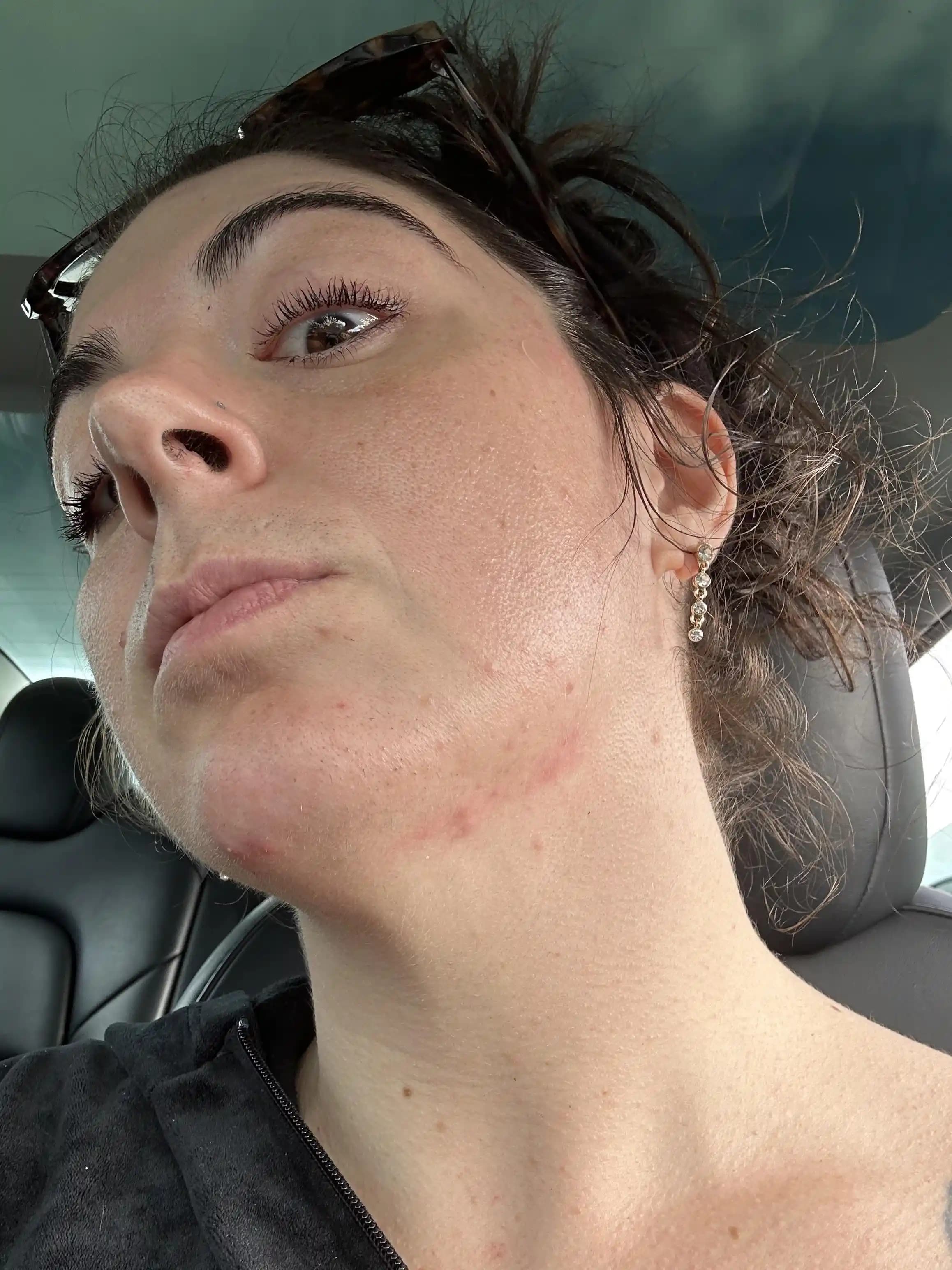 30'lu Yaşlarda Hormonal Akne ve Cilt Sorunları: Nedenleri, Tedavi ve Bakım Yöntemleri