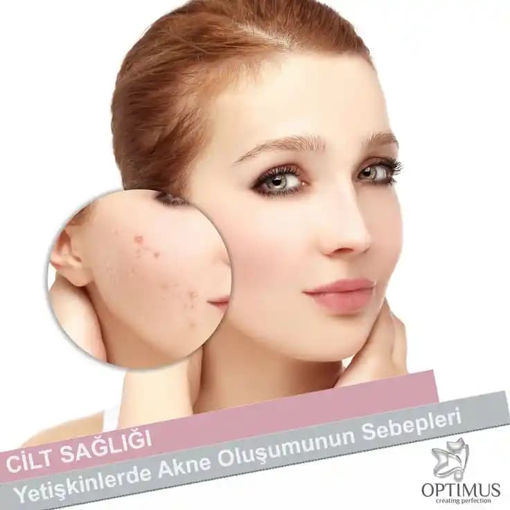 35 Yaşında Hormonal Akne Tedavisi: Etkili Yöntemler ve Önemli Noktalar