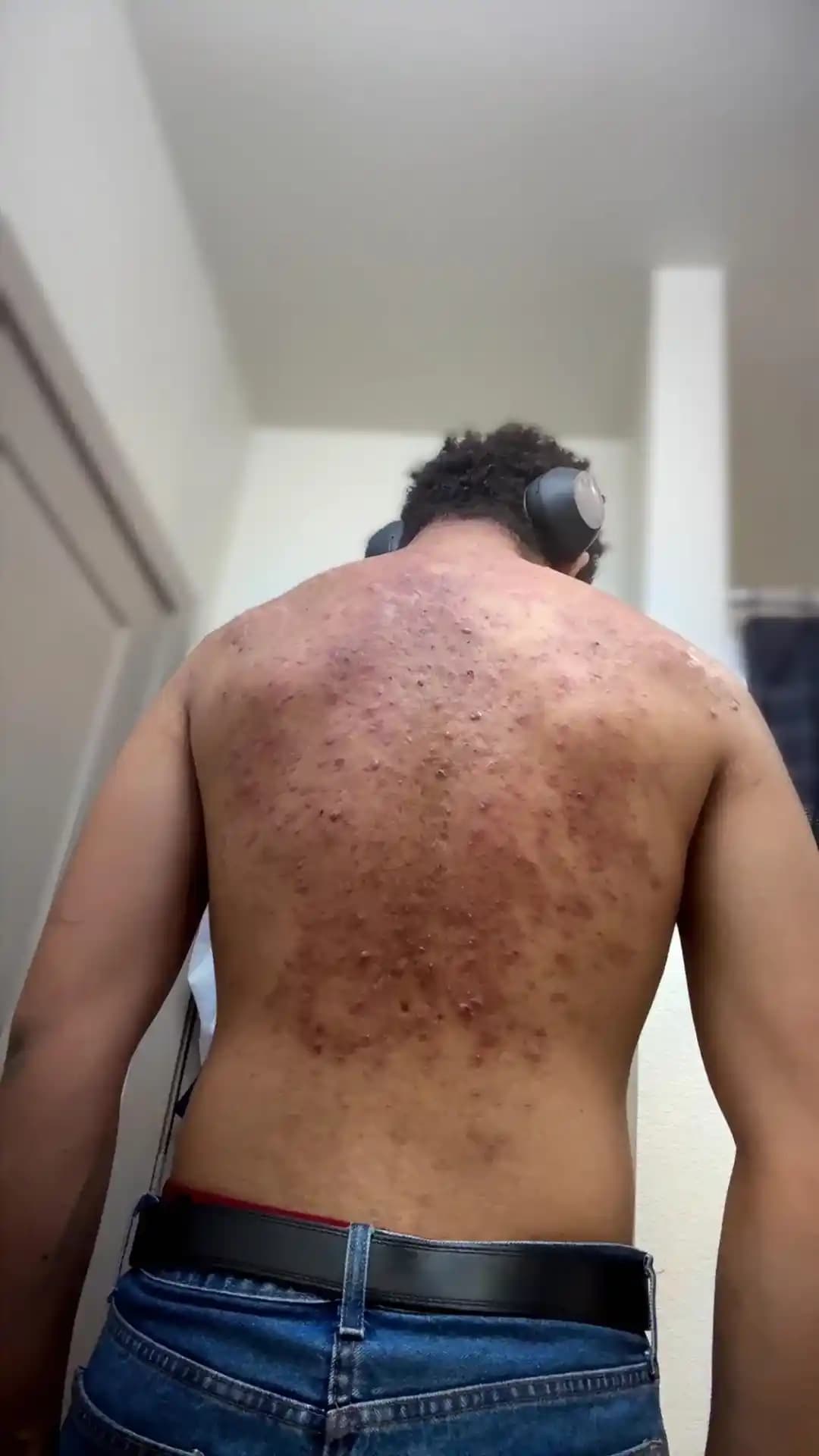 Akne Tedavisinde Accutane Kullanımı: Etkileri, Yan Etkileri ve Kullanıcı Deneyimleri