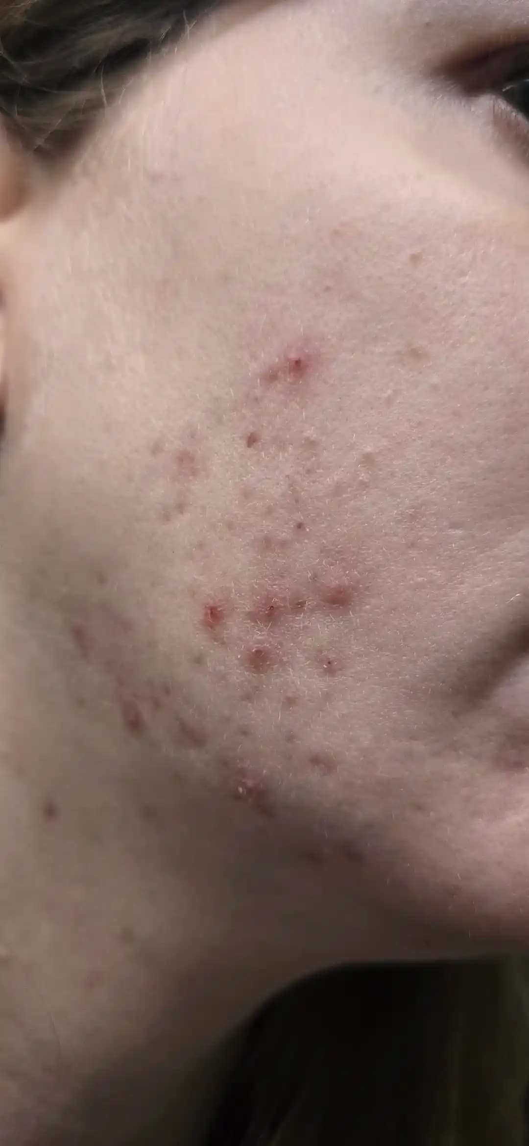 Akne Tedavisinde Dört Aylık Süreçte Etkili Cilt Bakım Rutini ve Ürün Kombinasyonları