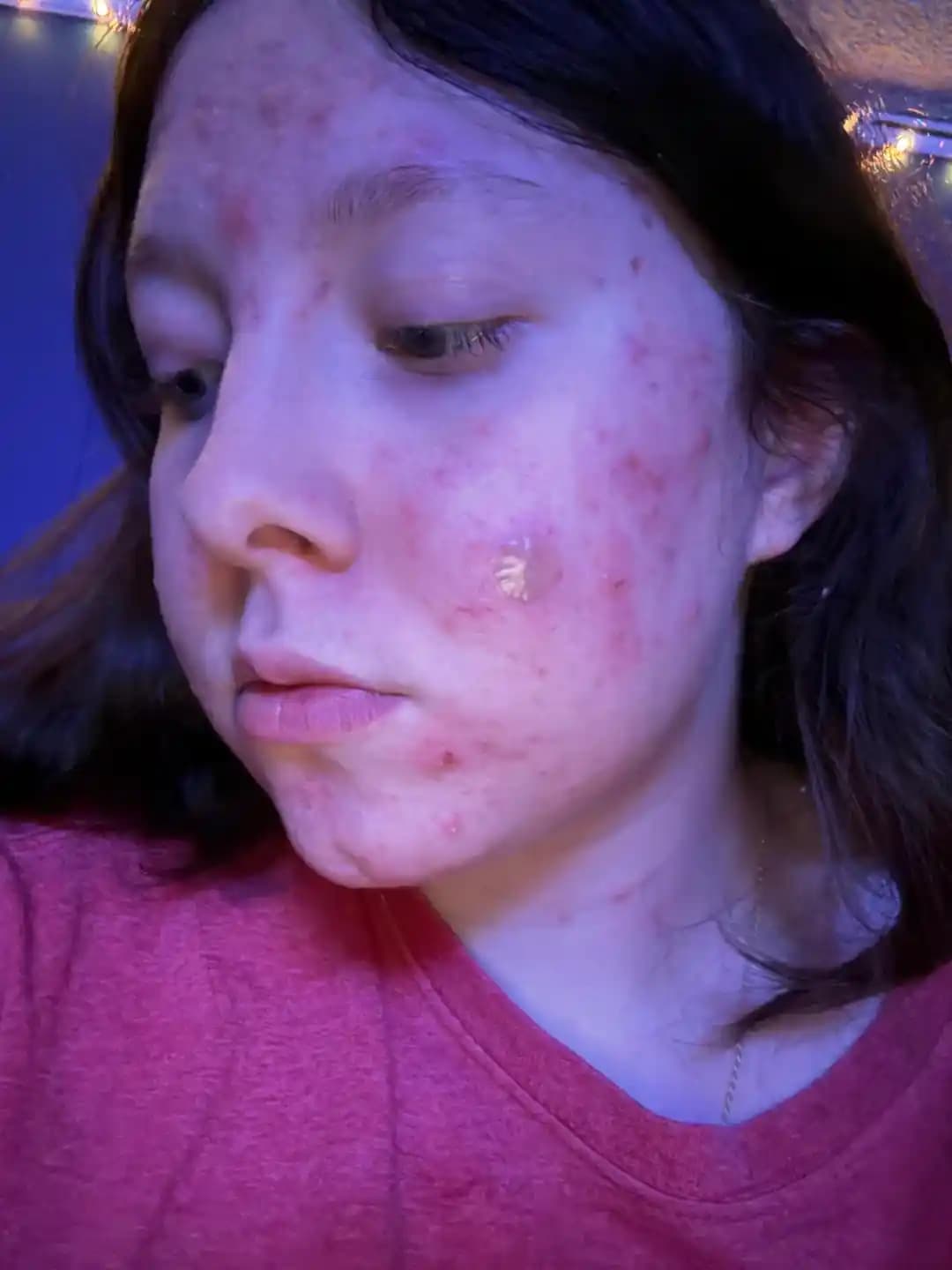 Akne Tedavisinde Etkili Yöntemler ve Psikolojik Destek Yaklaşımları