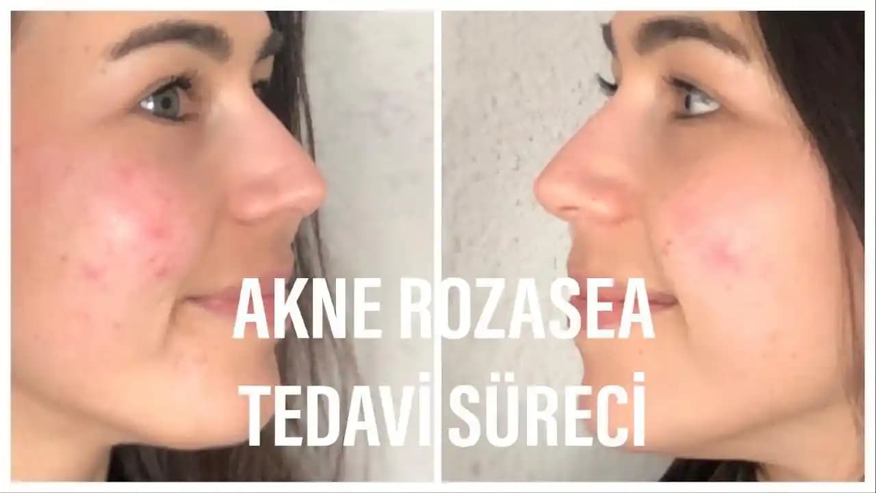 Akne ve Rozasea Tedavisinde Etkili Yöntemler ve Yaşam Kalitesini Artırma Stratejileri