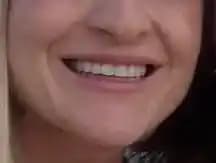 Botox Uygulaması Sonrası Gülüş Bozulması: Nedenleri, Tedavi Yöntemleri ve İyileşme Süreci