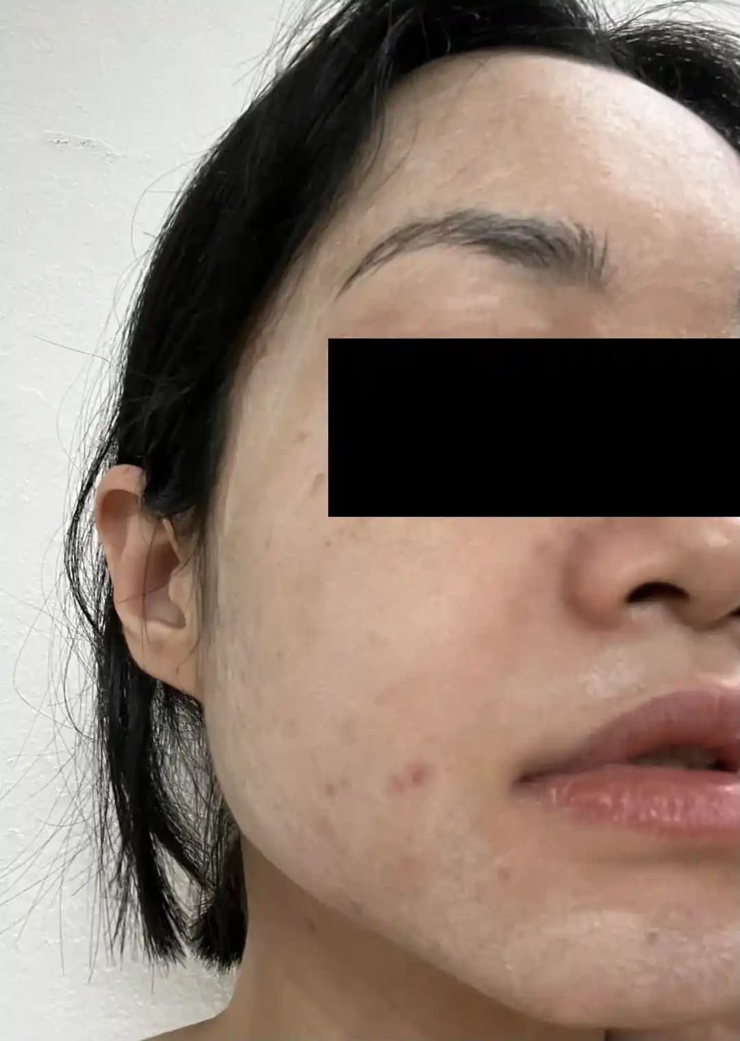 Cos de BAHA %15 Azelaik Asit Serumunun Yüzde Bıraktığı Beyaz Tabaka ve Çözüm Yöntemleri