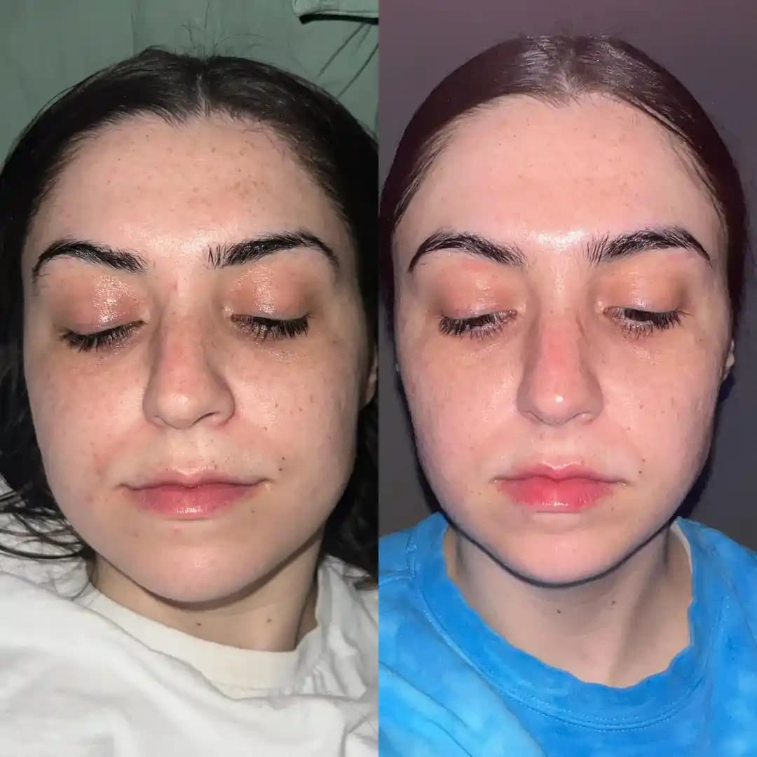 CurrentBody Multi Light LED Maskesi ile 90 Günlük Düzenli Cilt Bakımı ve Etkileri